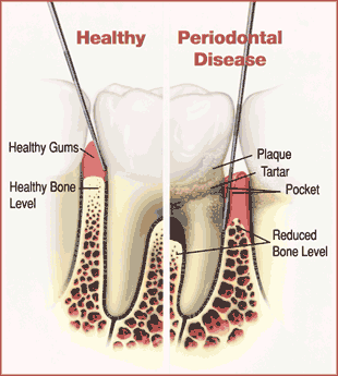Diagram comparing healthy and diseased gums